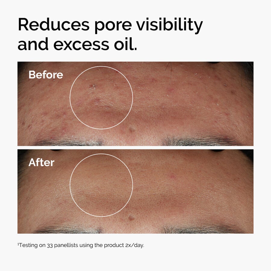 niacinamide-10-zinc-1-l9 ord-niacinamide-zinc-blemish-serum-before-after-pores.jpg