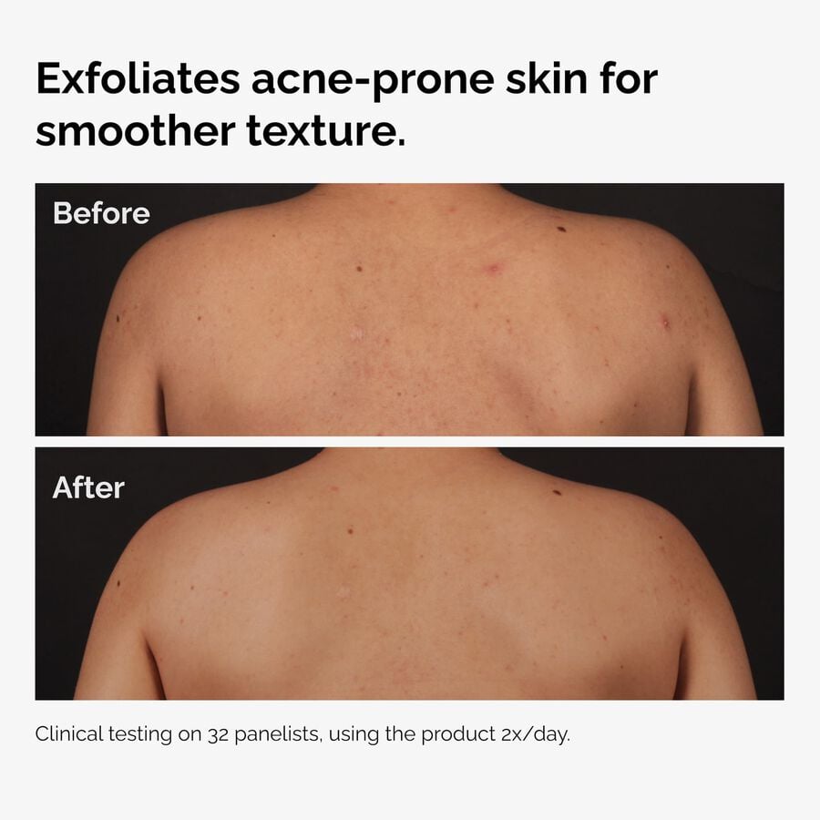 salicylic-acid-0-5-body-serum-m9 ord-salicylic-acid-body-serum-before-after-graphic-NA.jpg